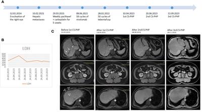 Successful application of chemosaturation with percutaneous hepatic perfusion in metastatic uveal melanoma patient progressing after systemic treatment options: a case report